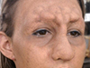 Prosthetic Nose, Forehead and Chin